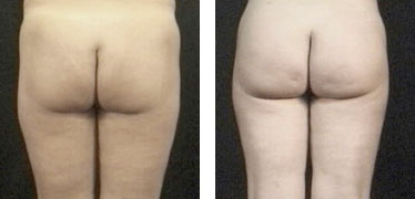 gluteoplastica3