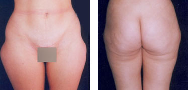 liposuzione2